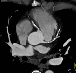 RCA and LAD Disease - CTisus CT Scan