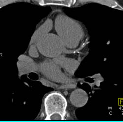 LAD Disease - CTisus CT Scan