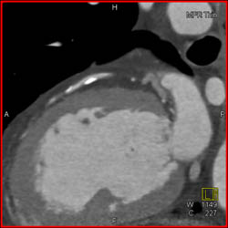 LAD Disease - CTisus CT Scan