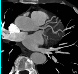 Normal Left Circulation - CTisus CT Scan