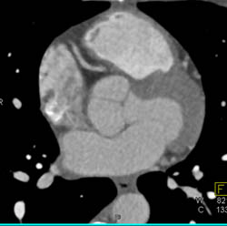 RCA Arises Off Left Cusp - CTisus CT Scan