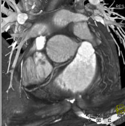 RCA Arises Off Left Cusp - CTisus CT Scan