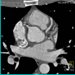 Normal LAD - CTisus CT Scan