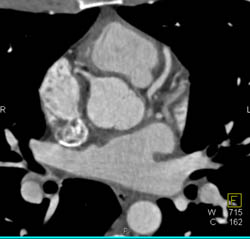 Normal LAD - CTisus CT Scan