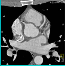 Normal LAD - CTisus CT Scan