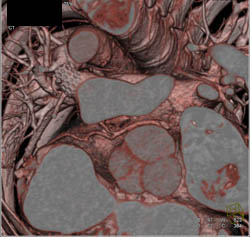 Stent in Pulmonary Artery in Corrected Transposition of the Great Vessels -togv - CTisus CT Scan