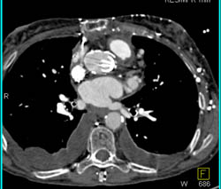 Aortic Valve Replacement and Collaterals - CTisus CT Scan