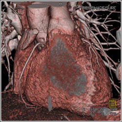 Normal Coronary Arteries - CTisus CT Scan