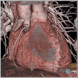 Normal Coronary Arteries - CTisus CT Scan