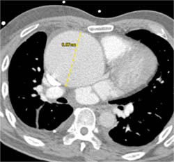 Dilated Aortic Root - CTisus CT Scan