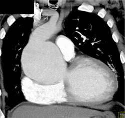 Dilated Aortic Root - CTisus CT Scan