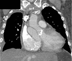 Dilated Aortic Root With Dissection - CTisus CT Scan