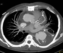 LAD Disease and Aortic Aneurysm - CTisus CT Scan