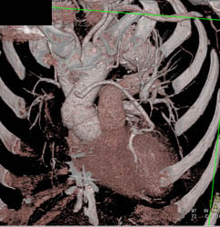 Venous Bypass Graft - CTisus CT Scan