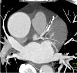 Diseased LAD and Circumflex - CTisus CT Scan