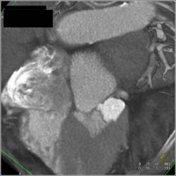 Aneurysm of Left Circumflex Coronary Artery - CTisus CT Scan