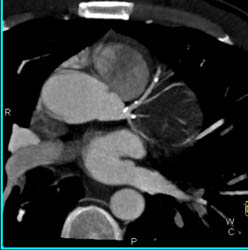 LAD Disease - CTisus CT Scan