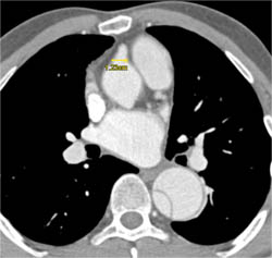 Dilated Reimplanted RCA in Ascending Aorta - CTisus CT Scan