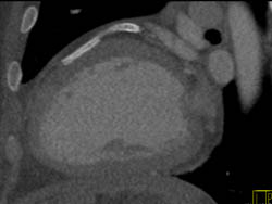 LAD Stents - CTisus CT Scan