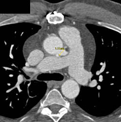 Dilated Reimplanted RCA and Left Main Coronary Artery - CTisus CT Scan