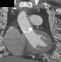 Aortic Valve Replacement (AVR) With Open Valve and Closed Valve - CTisus CT Scan