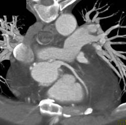 Dilated Origin Left Main Coronary Artery - CTisus CT Scan