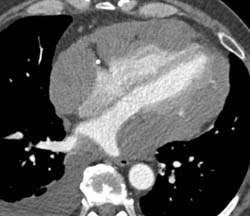 Angiosarcoma of the Pericardium - CTisus CT Scan