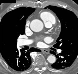 LAD Disease - CTisus CT Scan