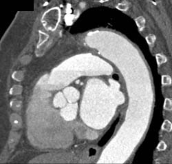 LAD Disease - CTisus CT Scan