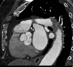 Calcification of Aortic Valve - CTisus CT Scan