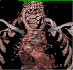 Prior Coarctation of the Aorta (COA) Repaired - CTisus CT Scan