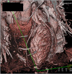 Normal LAD - CTisus CT Scan