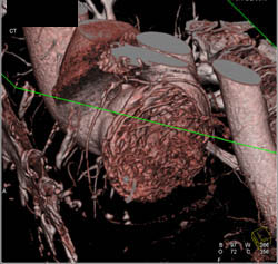 Normal LAD - CTisus CT Scan