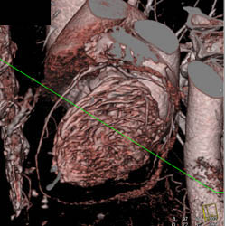 Normal LAD - CTisus CT Scan