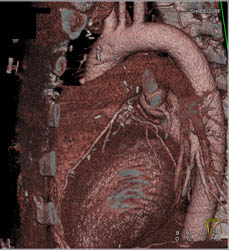 Failed Left Internal Mammary Artery (LIMA) Graft - CTisus CT Scan