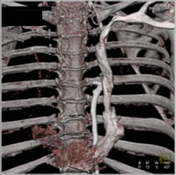 Left Sided SVC - CTisus CT Scan