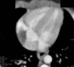 Cardiac Tumor in Right Atrium- Myxoma - CTisus CT Scan