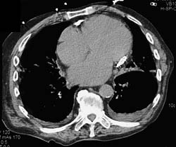 Pericardial Calcification - CTisus CT Scan