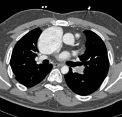 Enlarged Right Atrium and Pe - CTisus CT Scan