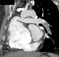 Pulmonary Embolism  in 3D - CTisus CT Scan