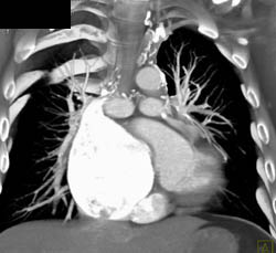 Large Right Atrium - CTisus CT Scan