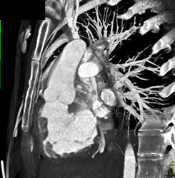 Dilated Aortic Root - CTisus CT Scan