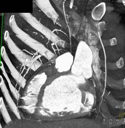 Dilated Aortic Root - CTisus CT Scan