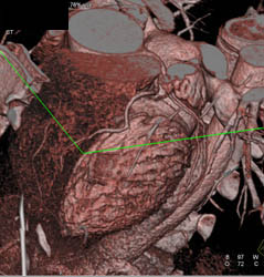 Normal LAD - CTisus CT Scan