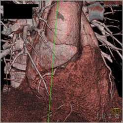 Normal RCA - CTisus CT Scan