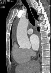 Dilated Ascending Aorta - CTisus CT Scan