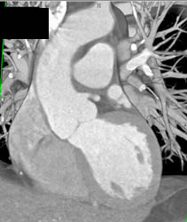 Dilated Ascending Aorta - CTisus CT Scan