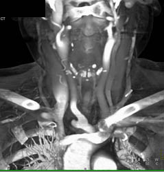 Occluded Right Subclavian Artery - CTisus CT Scan