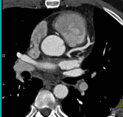 RCA Arises Off the Left Cusp in Multiple Views - CTisus CT Scan