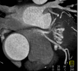 Calcified Plaque LAD W/o Stenosis in Multiple Views - CTisus CT Scan